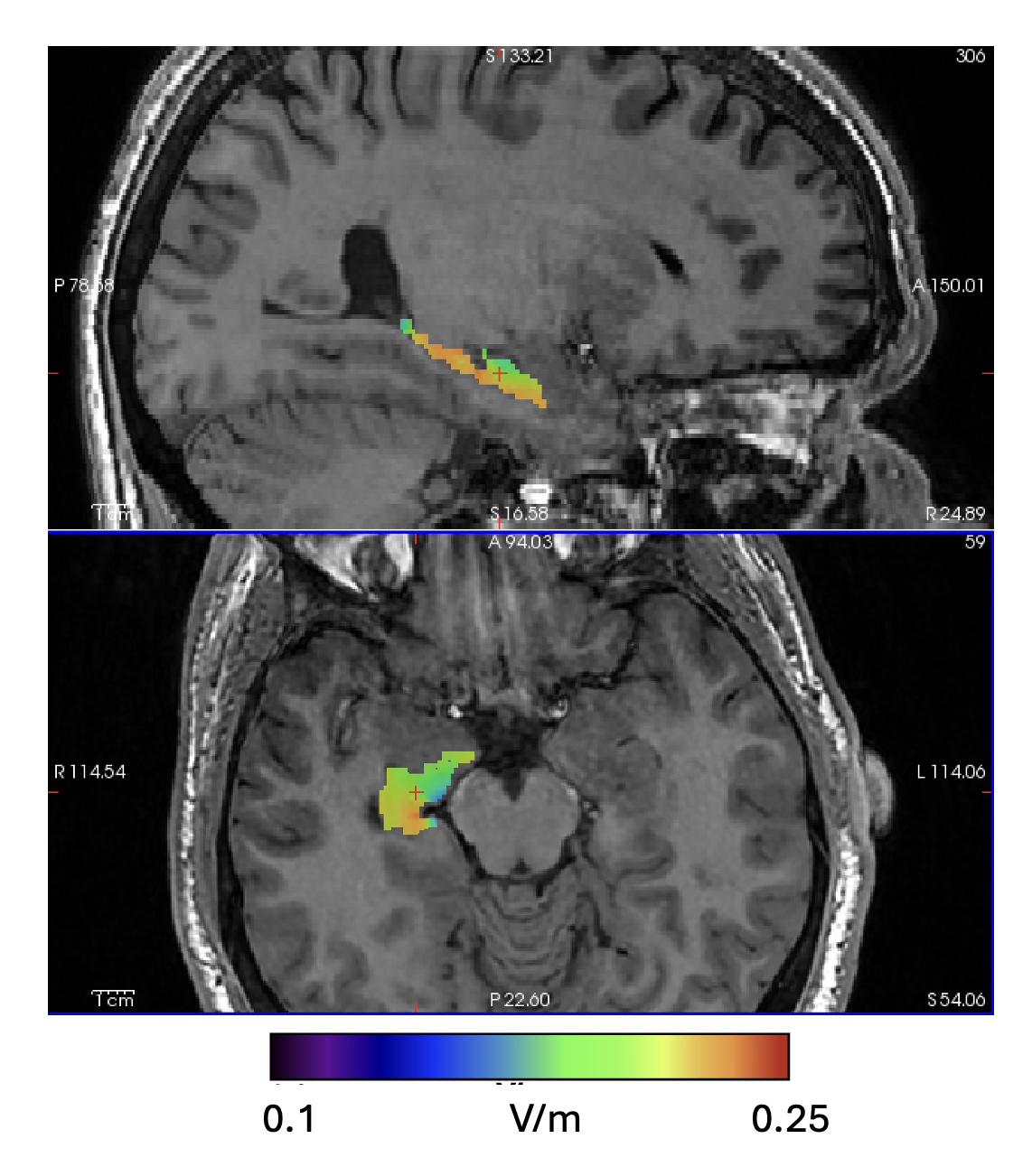 Spherical TI_max Analysis