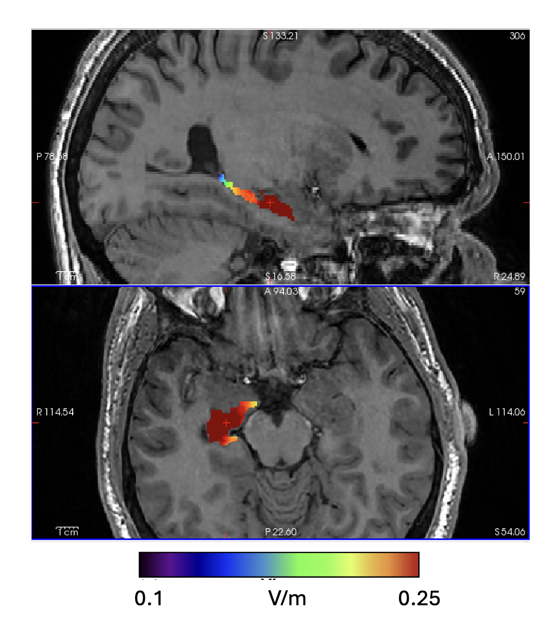 TInormal field in ROI (Right Hippocampus)