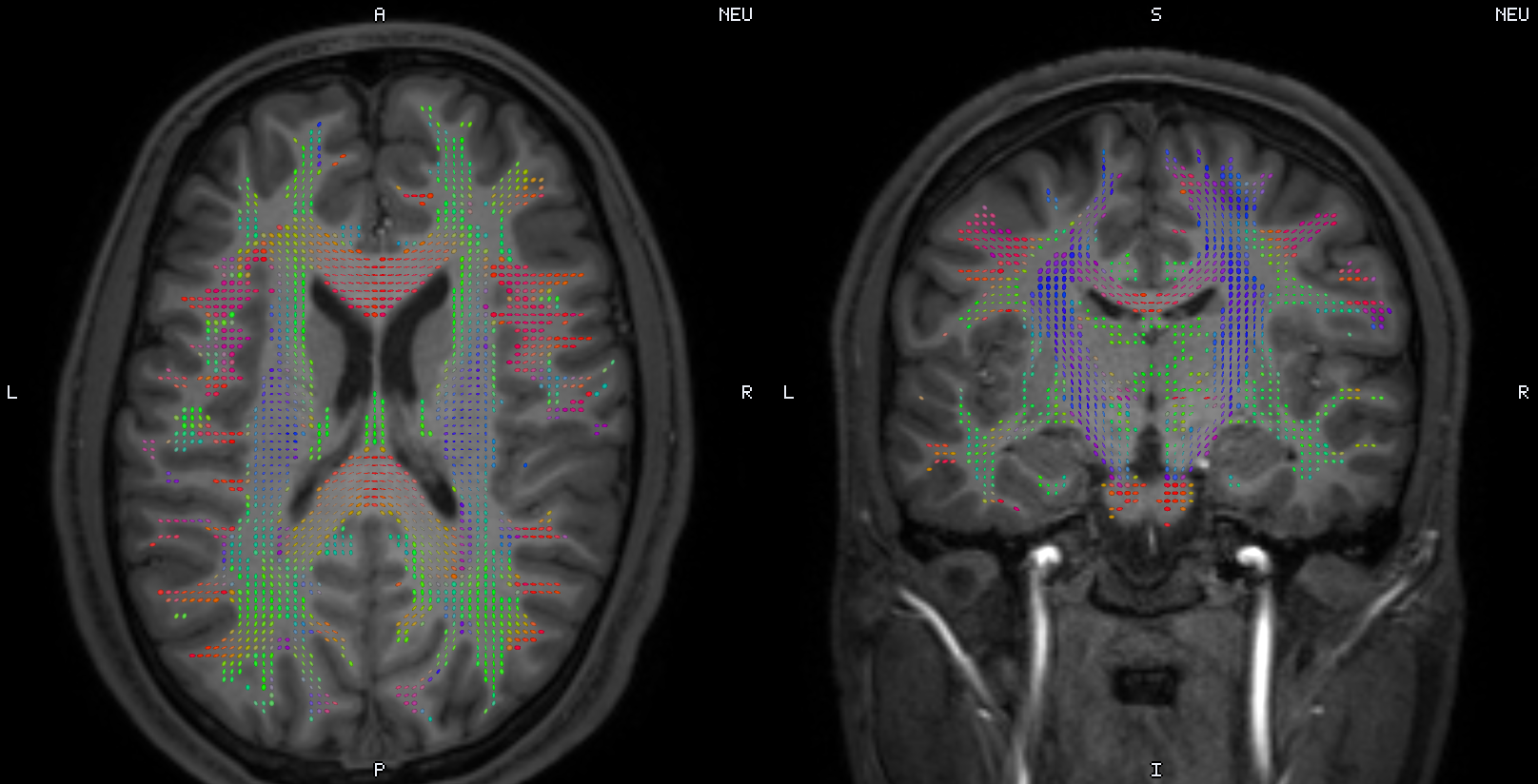 TetraVox view of the test subject Ernie's T1-weighted image with the corrected DTI tensor overlaid