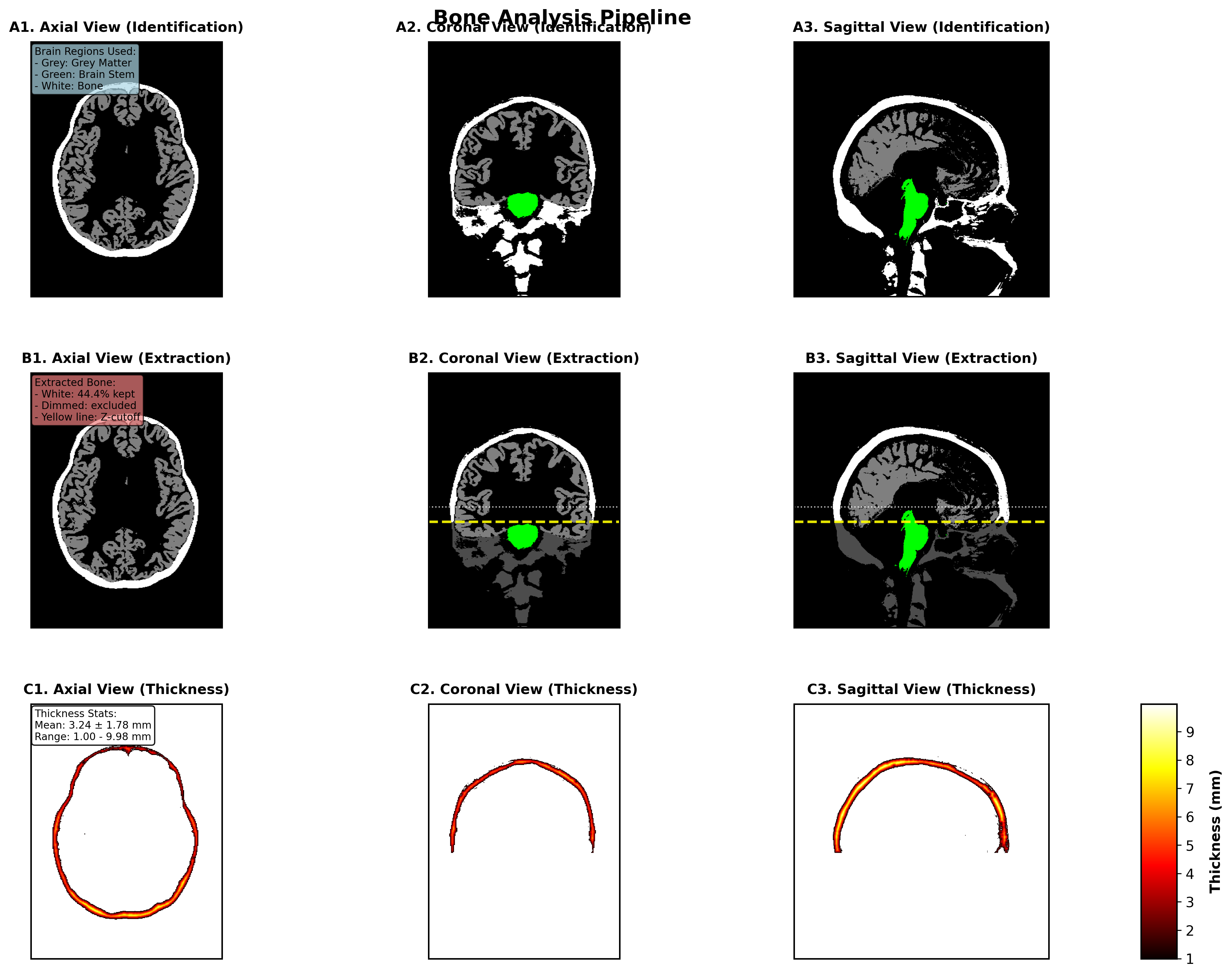Bone Analysis Figure