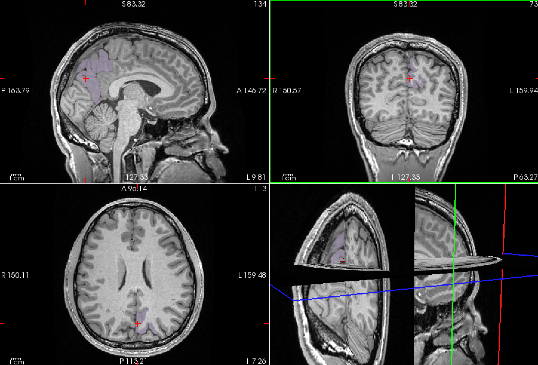 MRI ROI Analysis