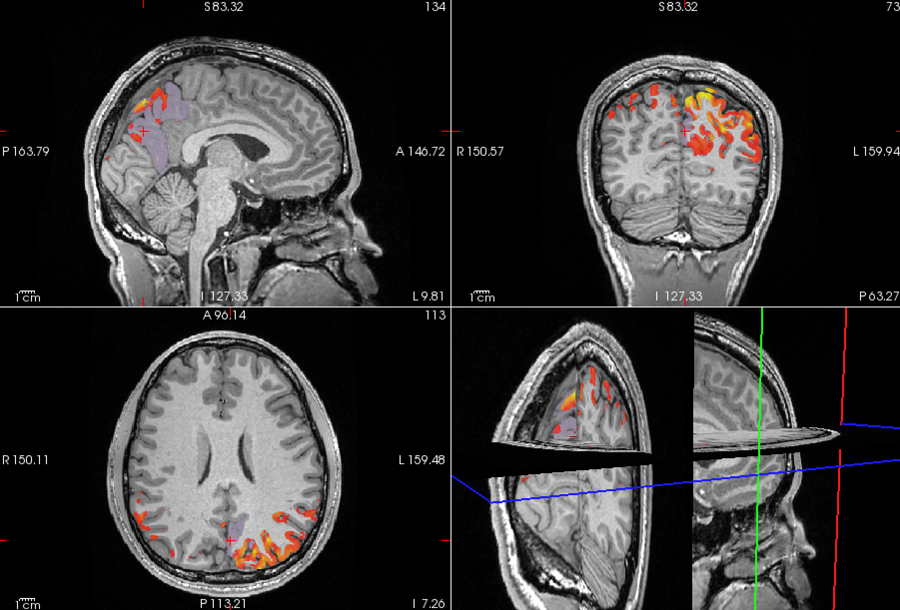 MRI ROI Field Analysis