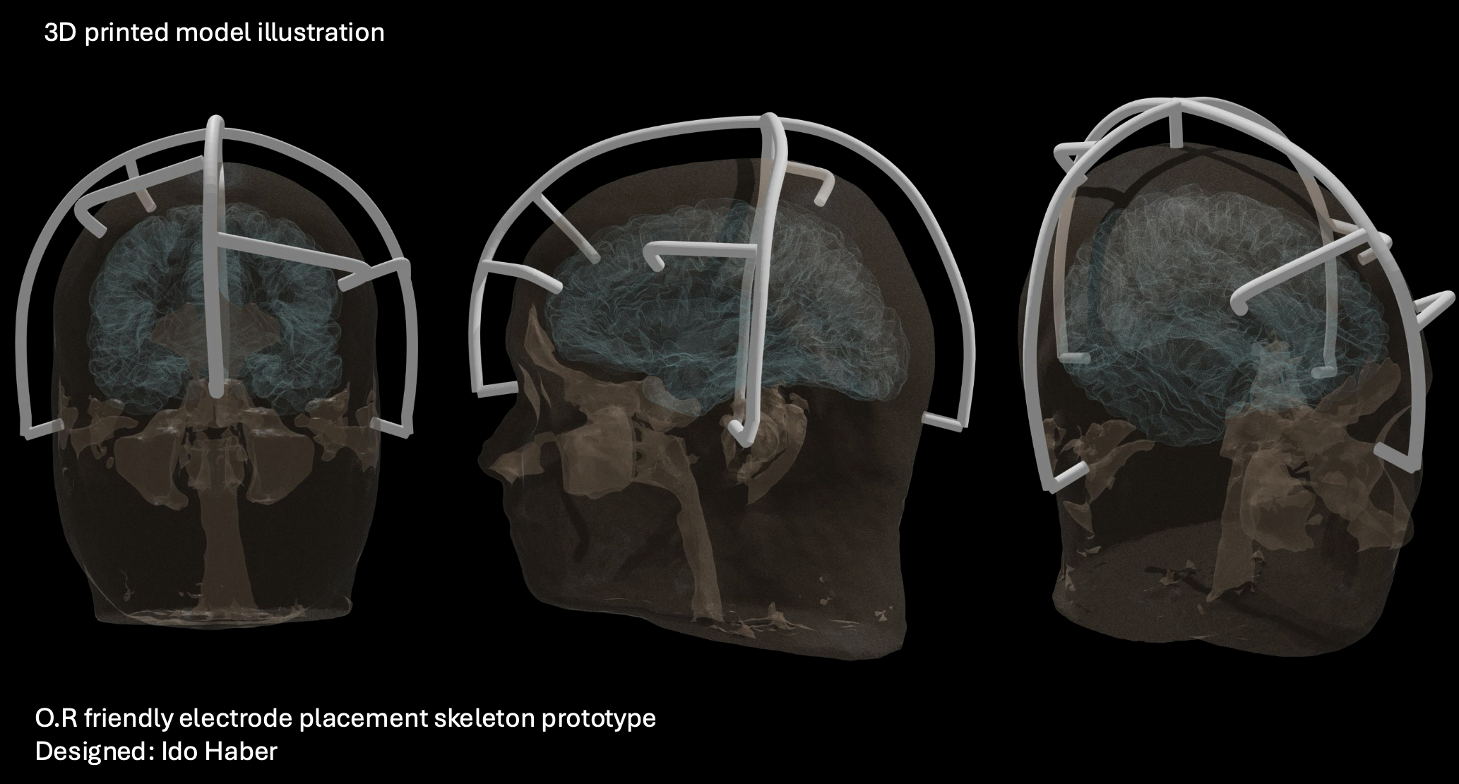 3D Blender illustration of the electrode placement system