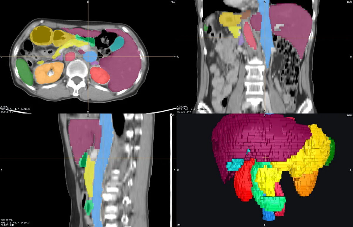 Abdominal CT + 15-organ labels