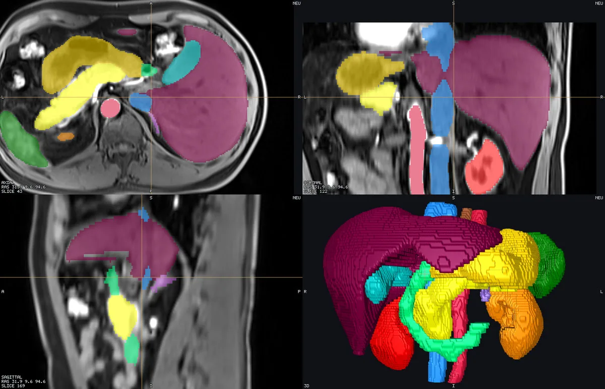 Abdominal T1 MRI + organ labels