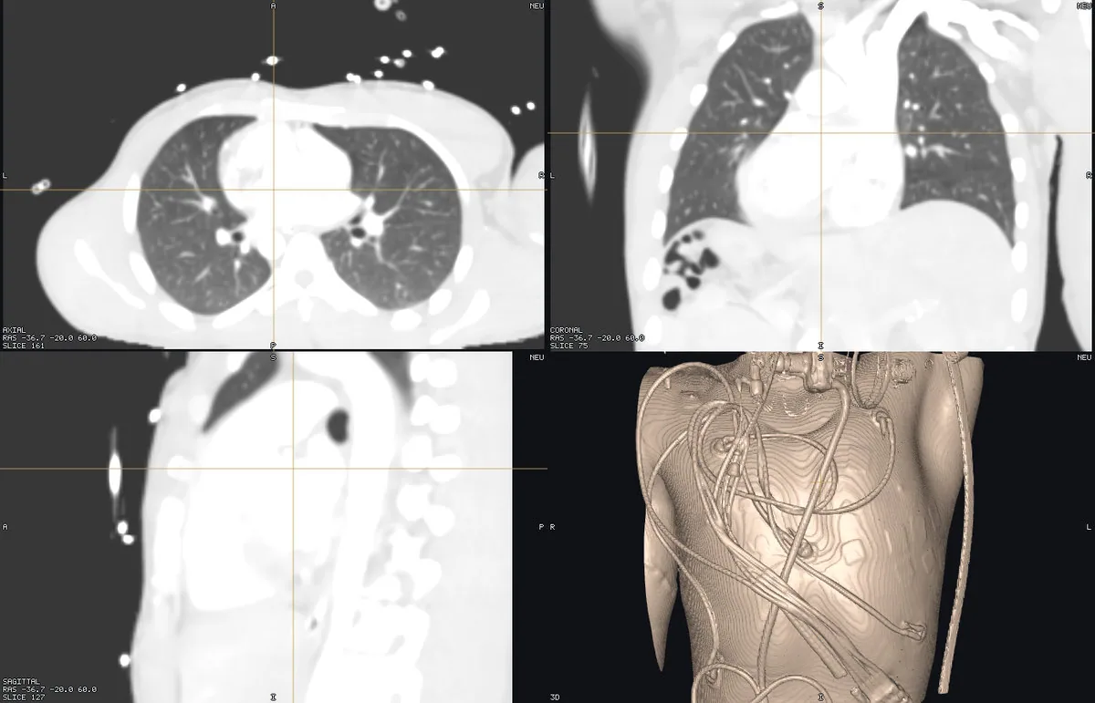 Contrast chest/abdomen CT