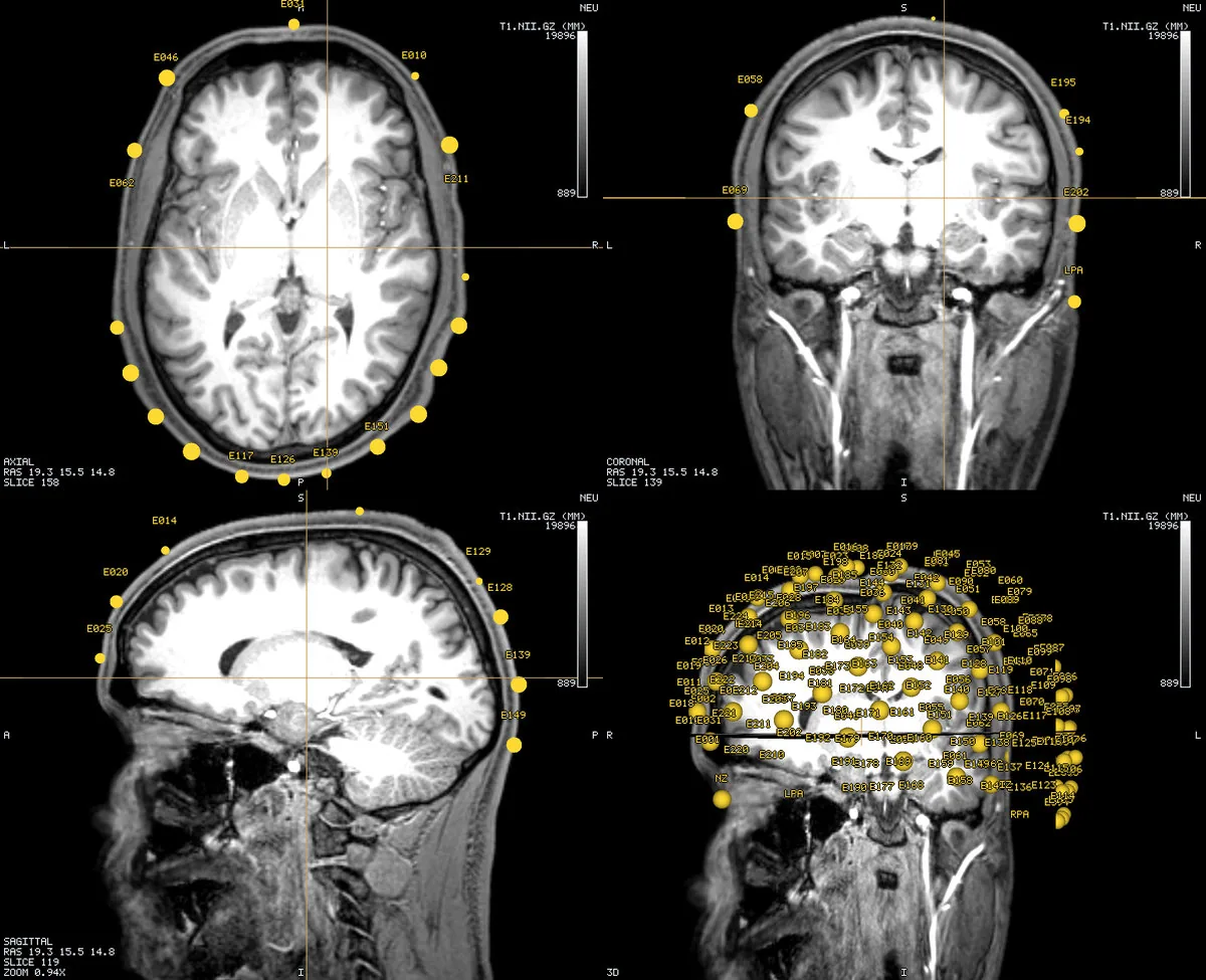 Head MRI + EEG 10-10 electrodes
