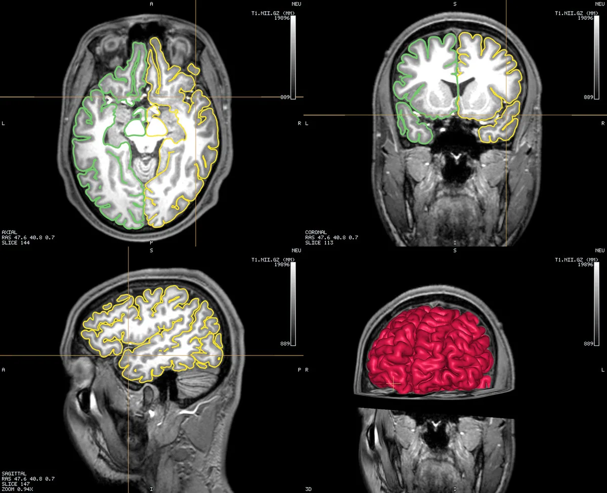 Head MRI + pial surfaces