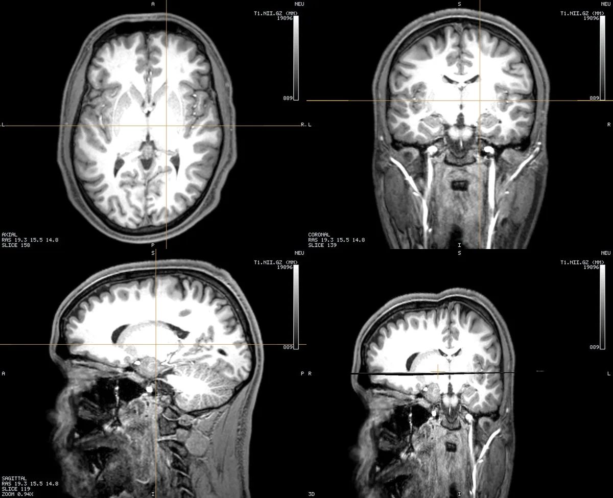Head MRI — T1