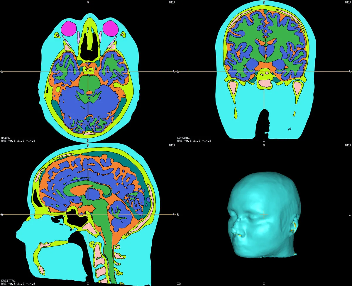 Head MRI + tissue segmentation