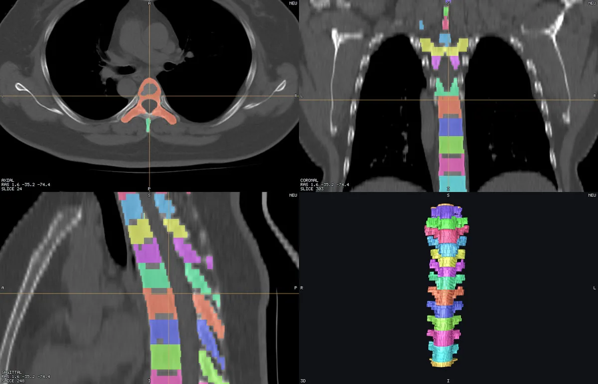 Chest CT + per-vertebra labels