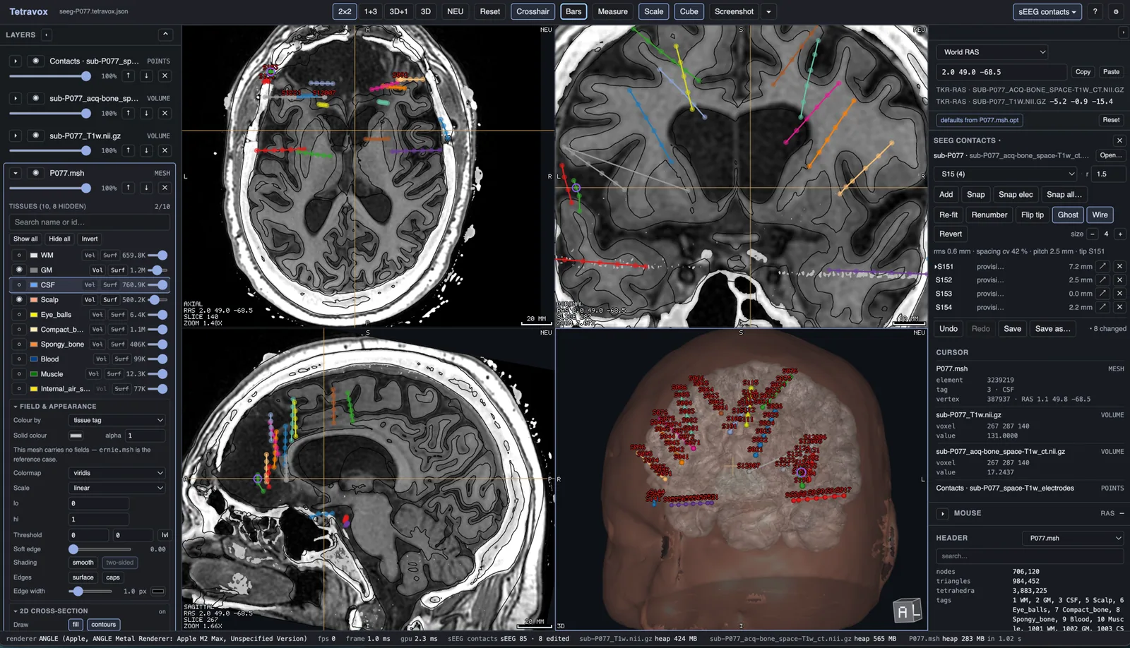 The sEEG contacts extension in Tetravox editing subject P077 — coloured electrode shafts across the 2×2 panes, the head mesh with labelled contacts in 3D, and the full SEEG CONTACTS panel with its electrode dropdown, Add / Snap / Re-fit / Renumber / Flip tip / Ghost / Wire controls, contact list, and Undo / Save.