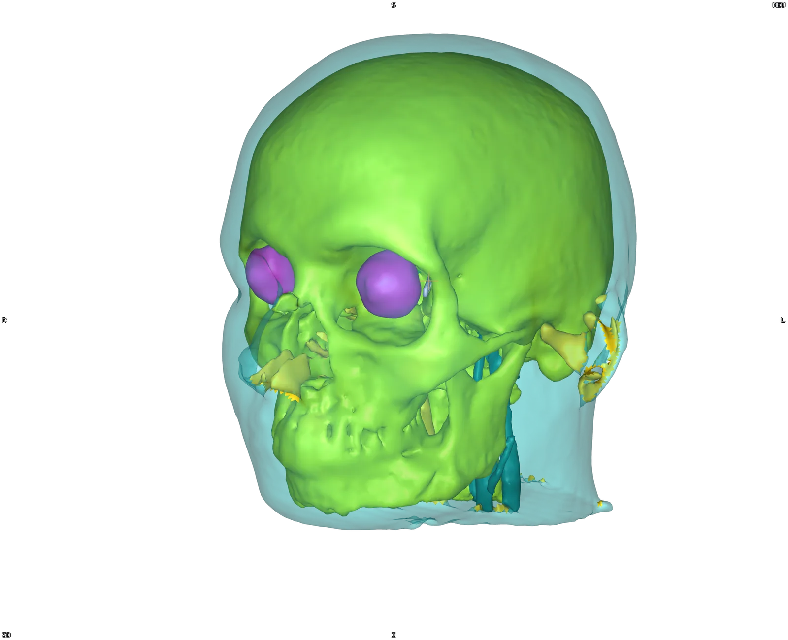 The skull through a translucent scalp, the brain tissues hidden