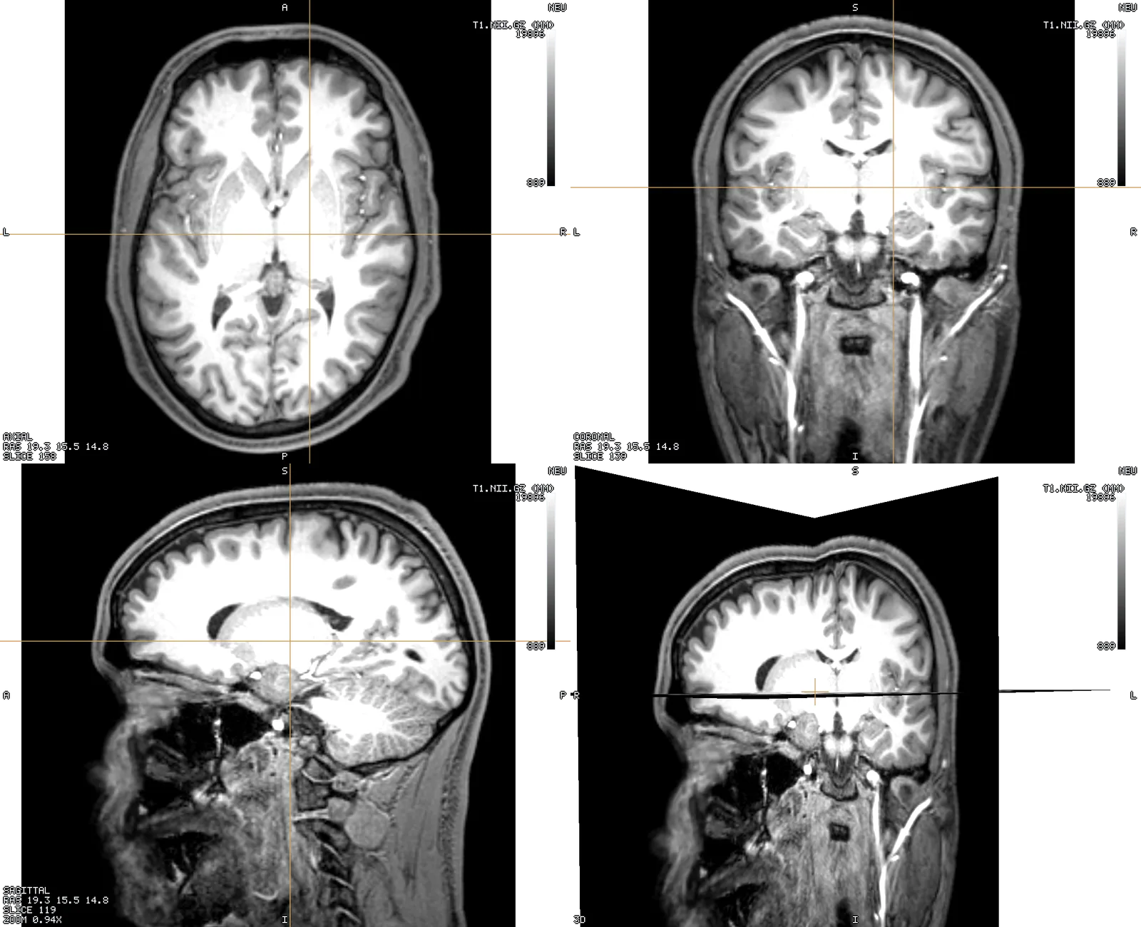 The 2x2 layout: three linked slices of a T1 and the 3D pane