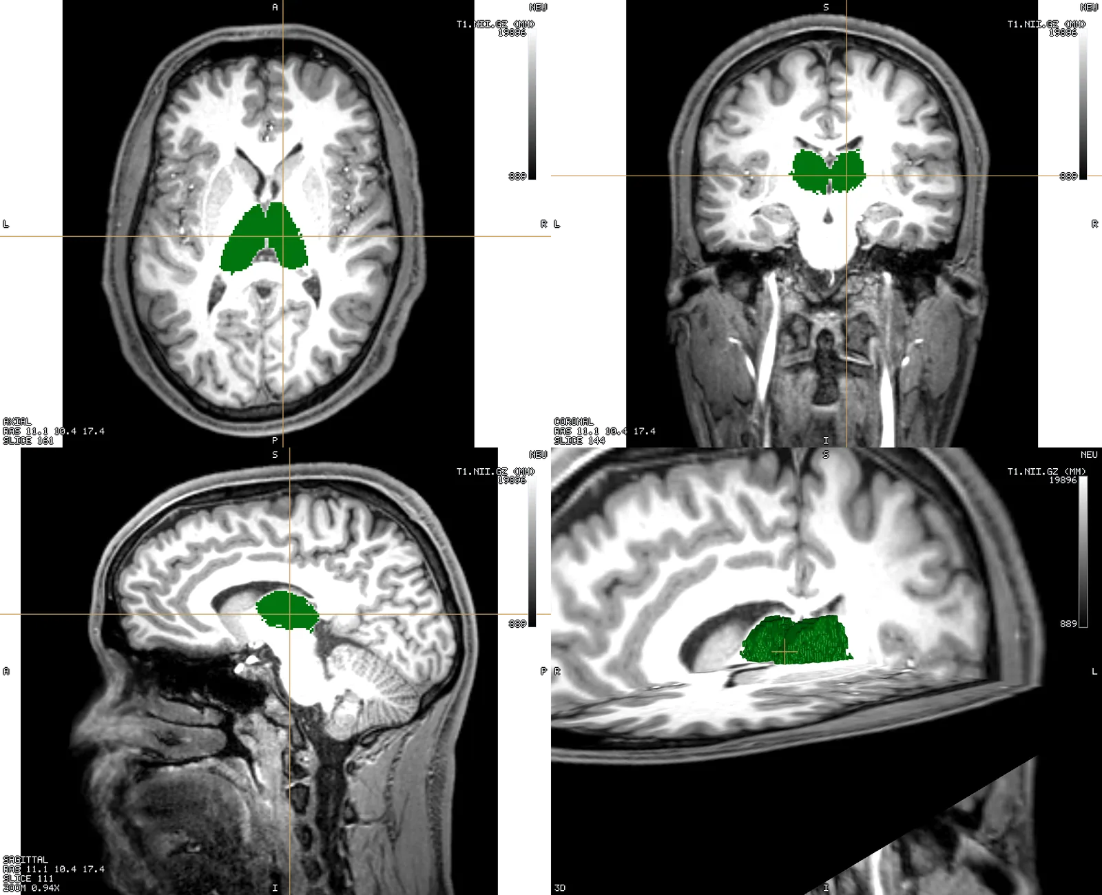The thalamus, soloed
