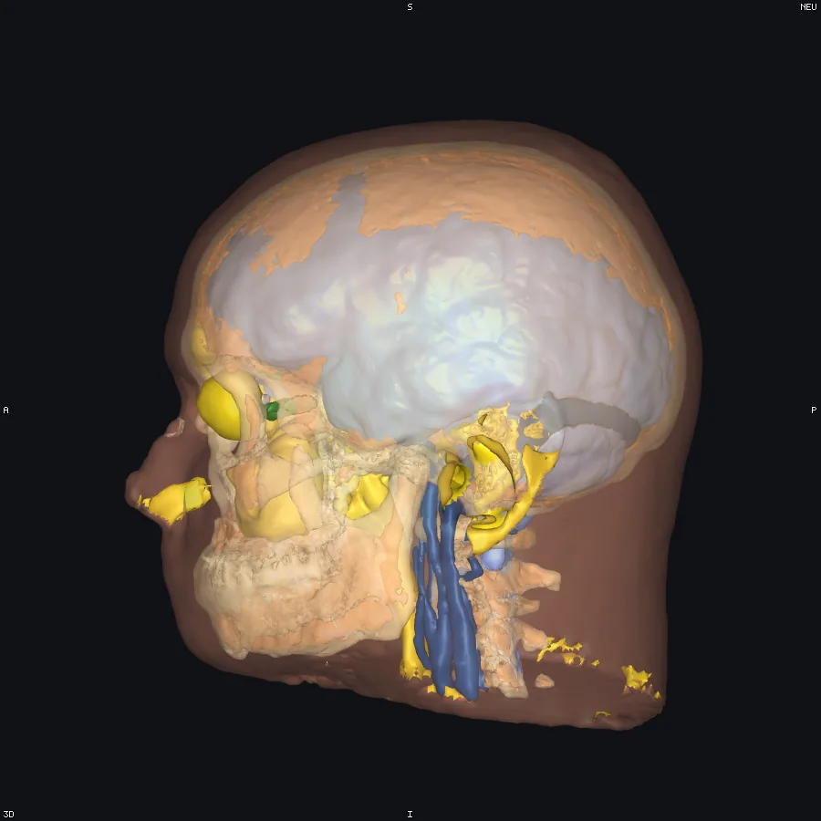 The head mesh with translucent scalp and skull, captured by screenshot.py