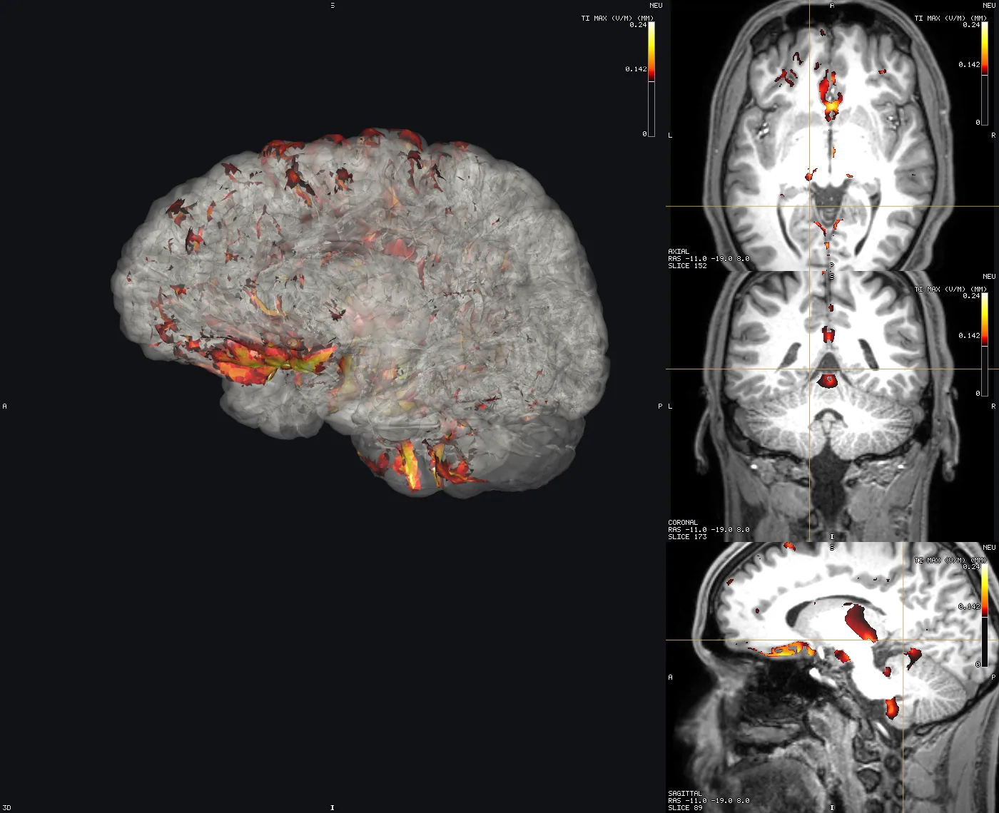 A simulated field as a thresholded heat overlay on a T1 and on the grey-matter mesh, produced by a job