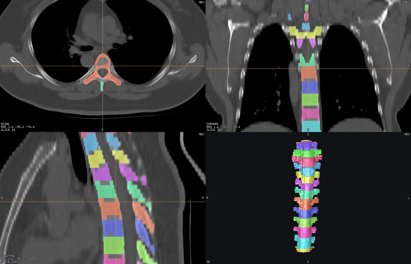 Chest CT with per-vertebra labels