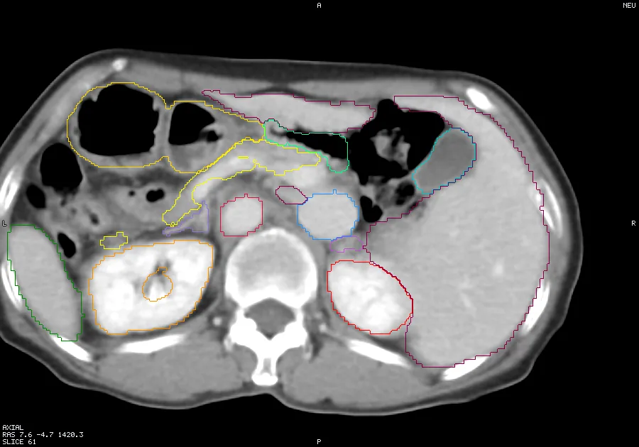 Abdominal CT with organ outlines