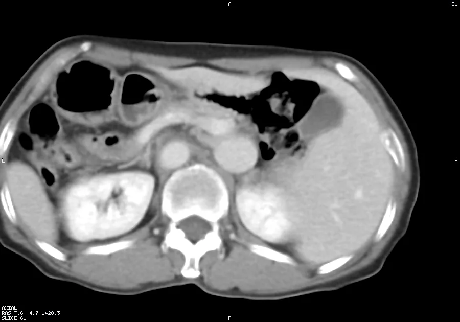 Abdominal CT, soft-tissue window