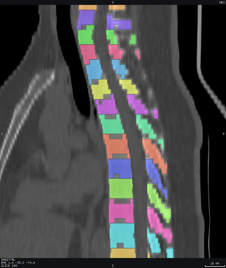 Spine CT with per-vertebra labels