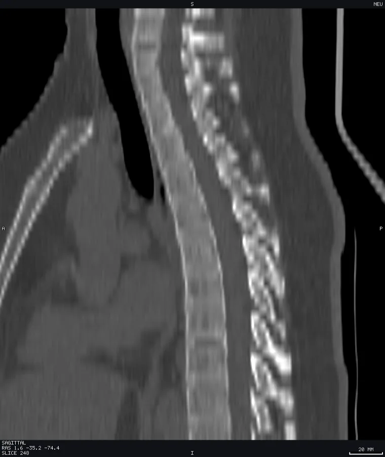 Spine CT, sagittal bone window
