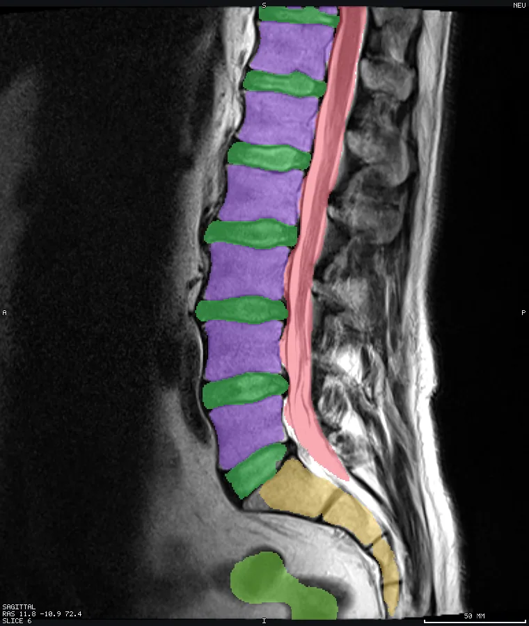 Lumbar spine MRI with labels