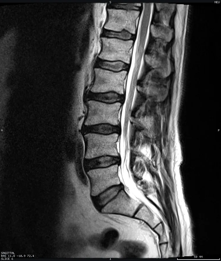 Lumbar spine MRI, sagittal