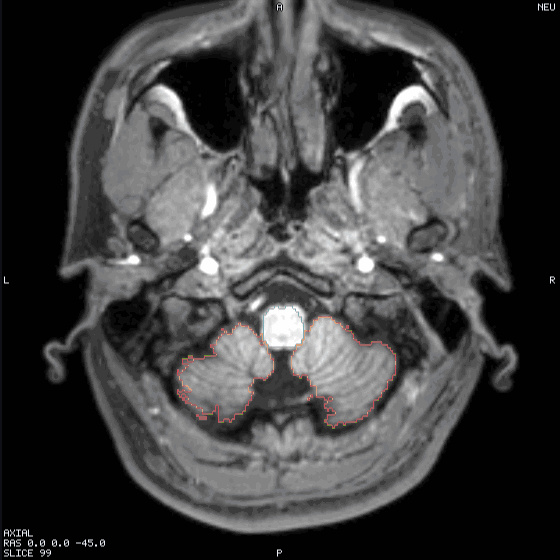 An axial sweep through a T1 with the atlas outlined